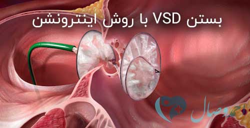 درمان بیماری VSD نقص دیواره بین‌بطنی