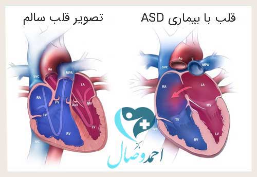 علائم عارضه سوراخ قلب بزرگسالان - بیماری ASD