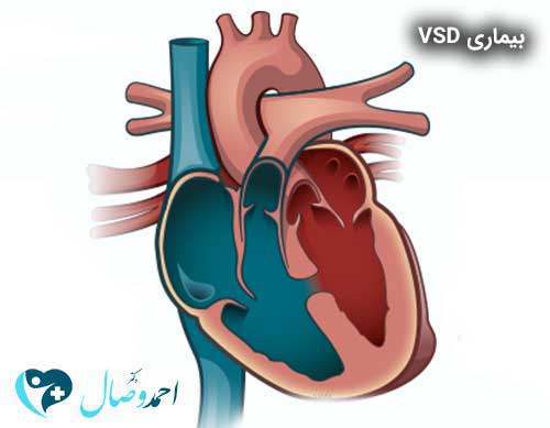 انواع سوارخ قلب ؛ نقص دیواره بین بطنی - VSD