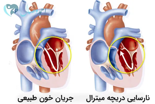 افتادگی دریچه میترال
