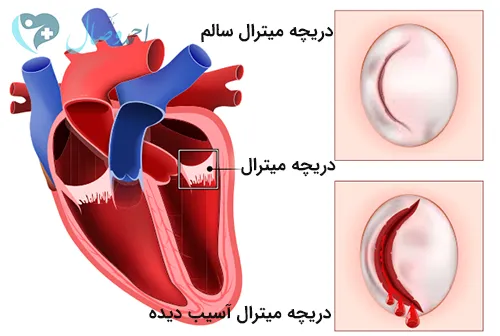 افتادگی دریچه میترال چیست؟